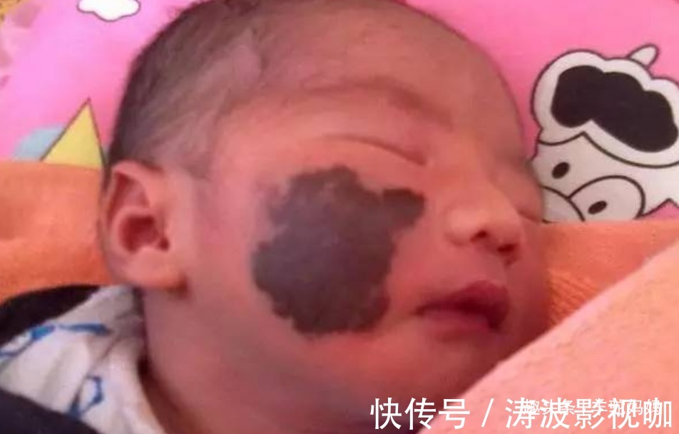 胎儿|越来越多胎儿被“胎记”缠身,若不想孩子自卑,孕妈要管住自己
