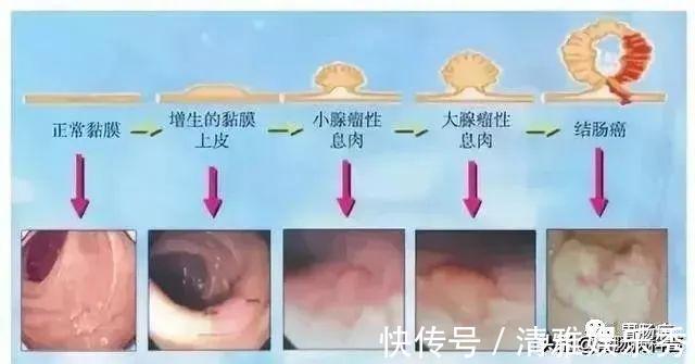 肠镜检查|做一次肠镜,到底管几年不得癌?是5年还是17年?