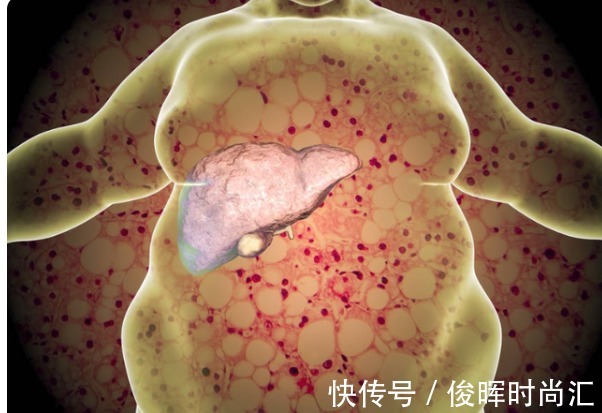 脂肪肝|年龄大了,就要常吃肉吗?医生提醒:过了50岁,不妨多吃这3种肉