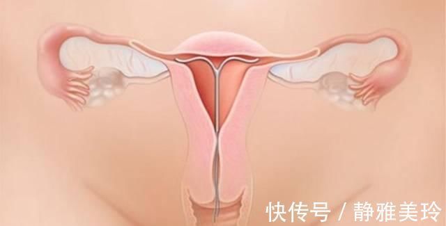 生育能力|不想生二胎了上环还是结扎,看完这两位宝妈的遭遇你会选什么?