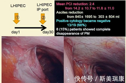 癌细胞|日本米村丰胃癌患者生存曲线:五年生存率达到47%!