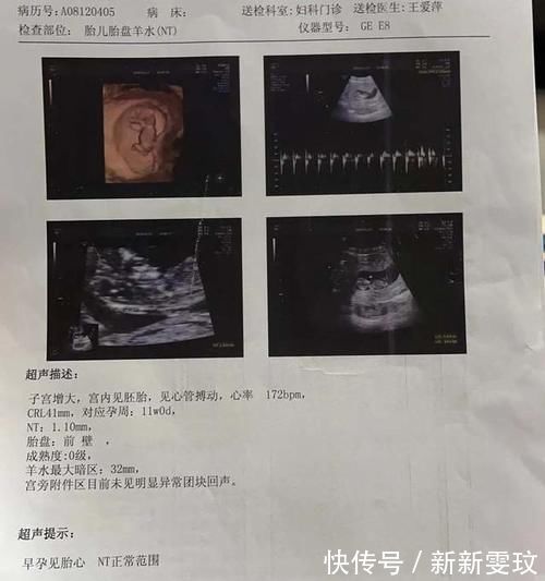 检查|接NT秒过!超级管用的注意事项!NT彩超一次性过!