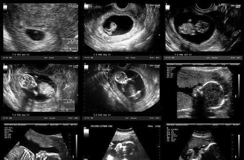 b超|每次产检结果正常,孩子生出后发现畸形,医院需要负责吗?