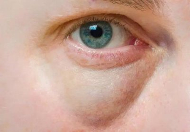 湿气|怎样祛眼袋中医还真有办法,支你3招,一招比一招强,女性要看