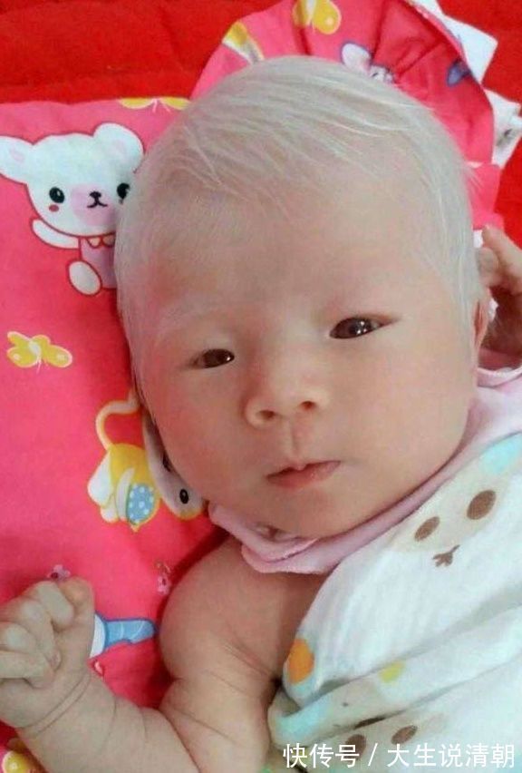张静|孕妇产下孩子一头白发,医生却说没什么!
