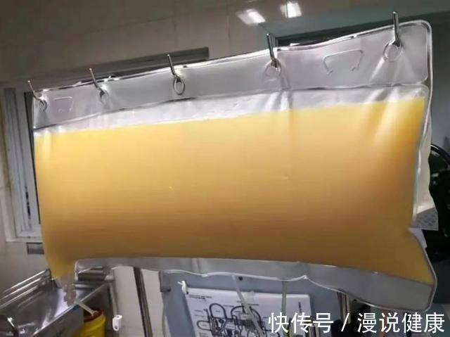 脂肪肝|男子体检血中抽出2升油浆?引起高血脂的这种习惯,很多人也都有