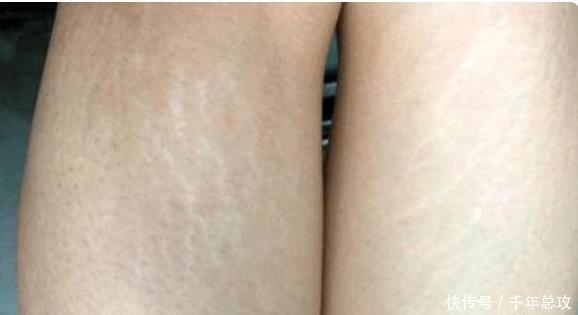 女生腿上一圈圈的纹是什么是因为肥胖导致的吗3招可有效消除