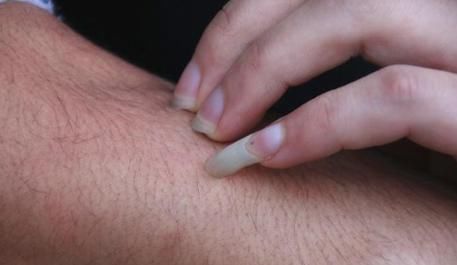 用鸡蛋就可以“祛湿”？湿气重的人，特征明显，稍加留意就可发现