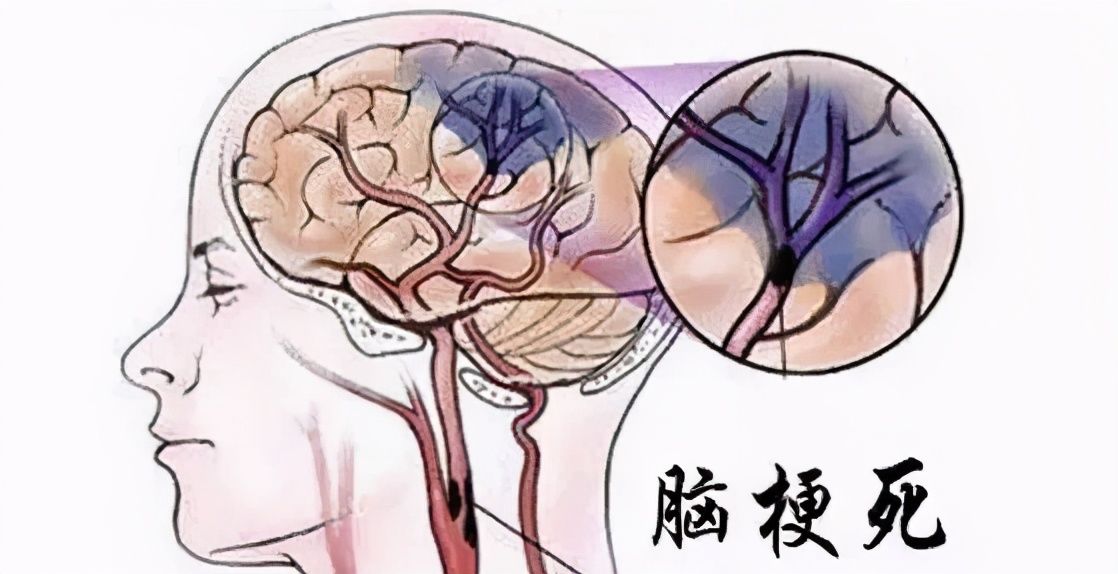 男子|34岁男子心梗加脑梗，这些坏习惯害了他！专家：80%脑卒中可预防