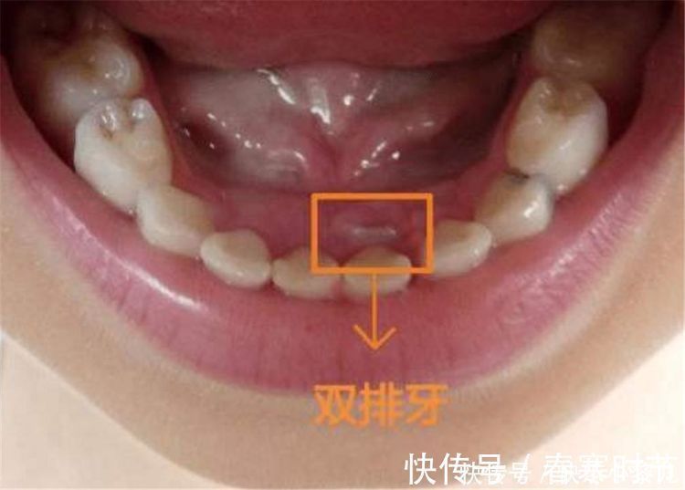 孩子|“双层牙”的孩子越来越多，和家长的习惯有关系，很多家庭仍在做