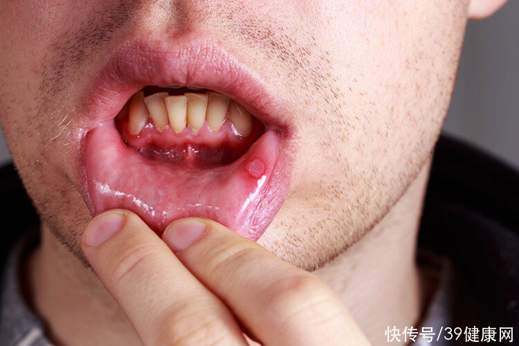 经验|口腔溃疡反复发作，是因为缺维生素？错误的“经验”误导太多人