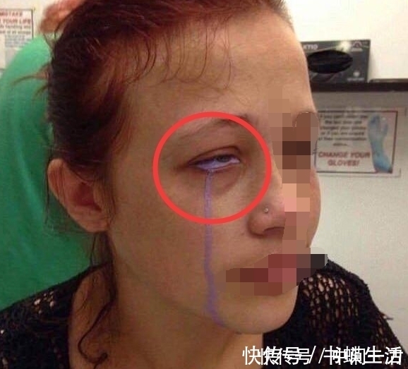 紫色|国外一女子，哭出来的是紫色眼泪，医生查出真相原因是纹身