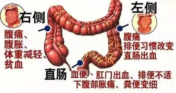 太大意，年轻小伙查出直肠癌！