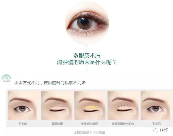 恢复|为啥割了双眼皮以后,你恢复的比别人慢