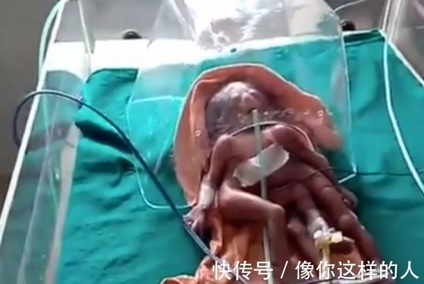 婴儿|女子怀孕10月,生下4手4脚异形婴儿,医生却这样解释!