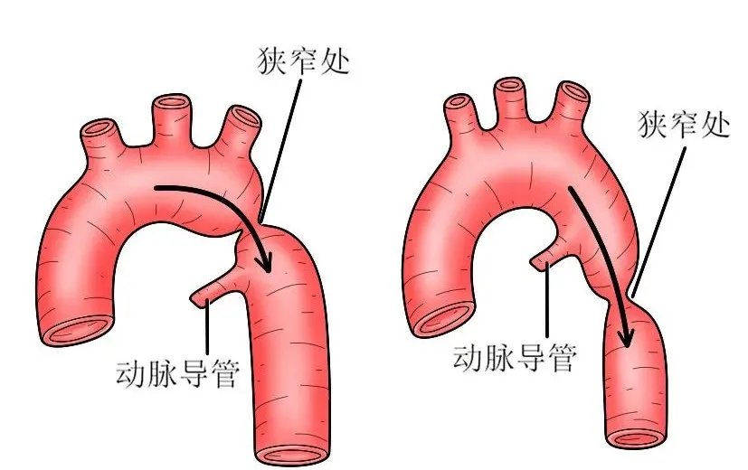 主动脉|打疫苗发现血压异常升高，48岁阿姨查出先天性疾病，血管严重窄缩像被“扎”了起来