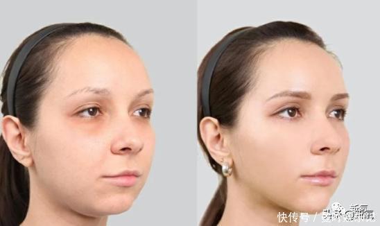 半个娱乐圈女明星脸上都有的这个坑，真的是线雕的锅吗？