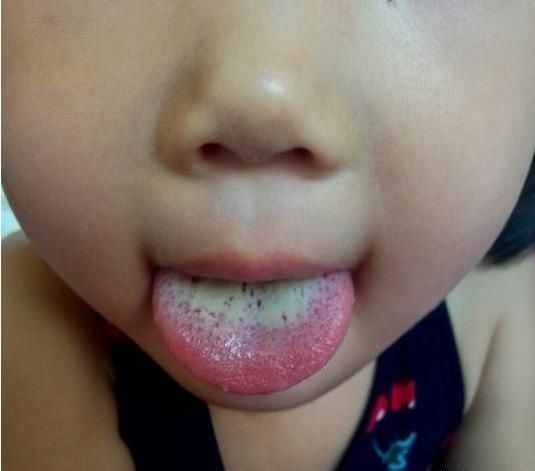 消食穴|孩子积食怎么办?中医师:身上有2个“消食穴”,揉一揉消除积食