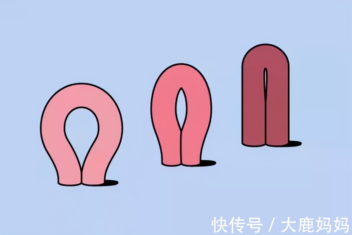 凯格尔|剖腹产和顺产究竟哪个好?听谁的?