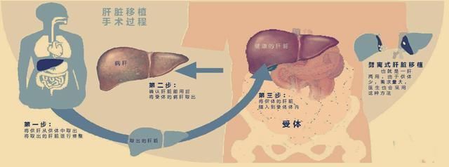 t22岁妹子罹患肝癌，医生建议肝移植，妹子思考良久：不做！