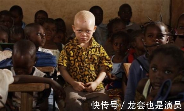 病人@非洲版“唐僧”:皮肤全白,血液比黄金还贵,死后遗骸能卖上百万