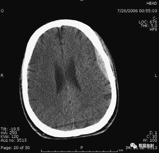 疾病|急诊颅脑CT不能漏的8种疾病