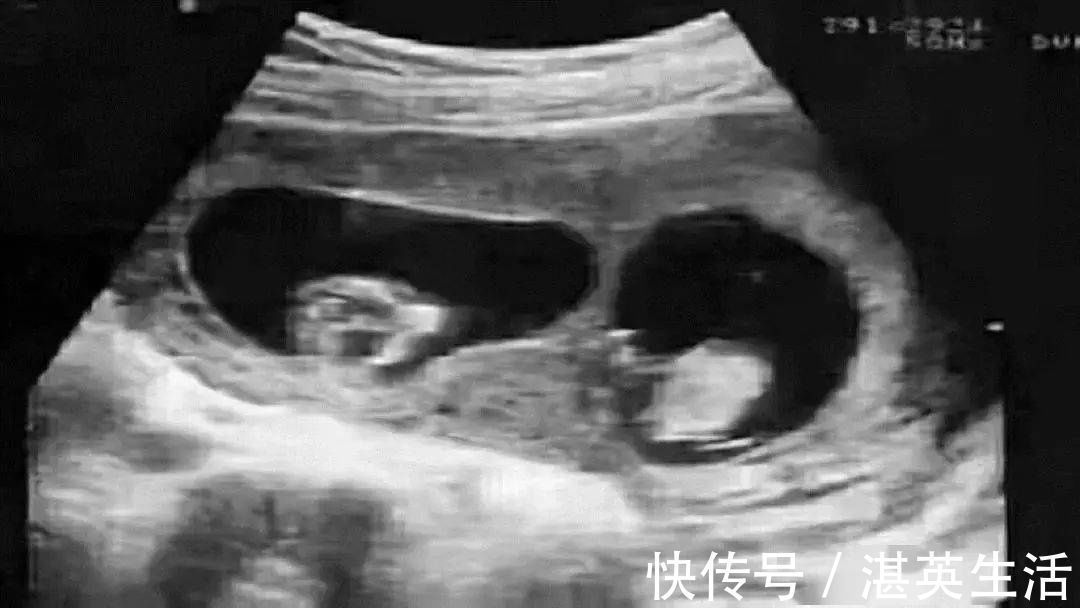 三倍体|娃是亲爹的,验DNA却是亲叔的,从生物学角度如何解释?