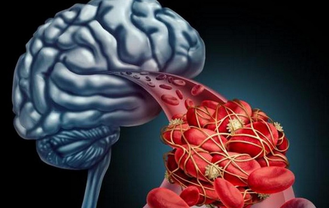 红烧茄子|65岁大妈每天吃素,却突发脑梗离世,建议少吃这3种菜