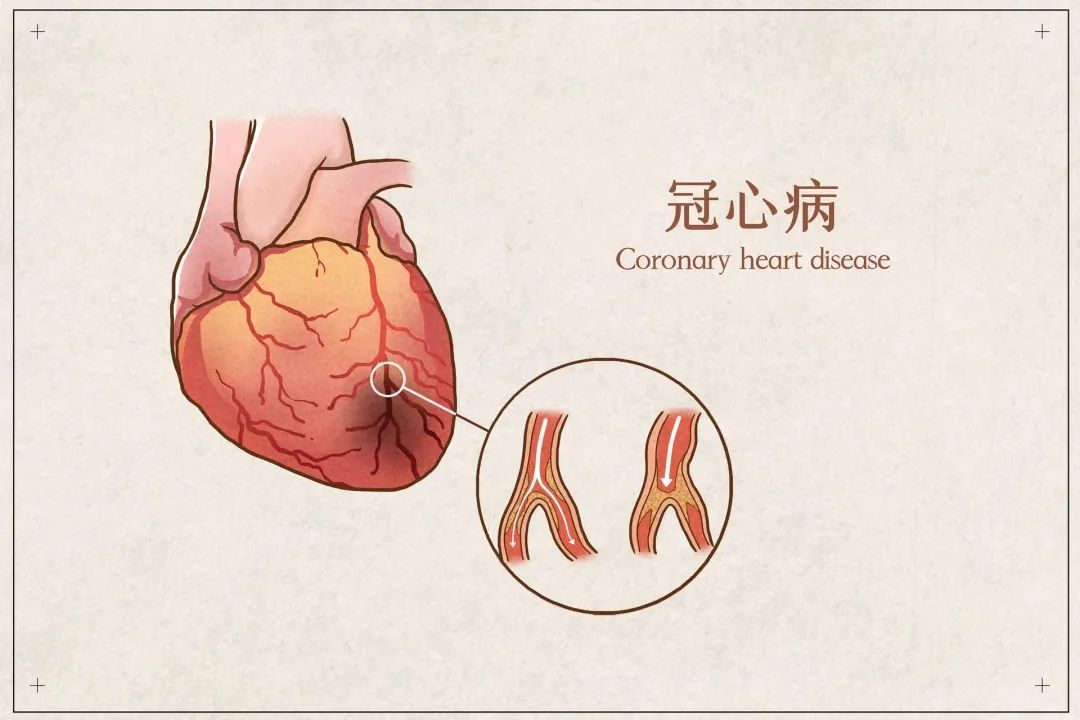 冠心病死亡率高居不下，这些知识你得清楚！