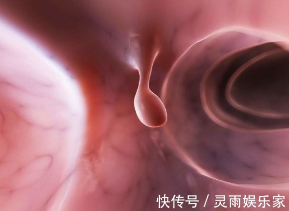 肠息肉|3种肠息肉一定要及时切除，没事常吃3种食物，可更好预防肠癌