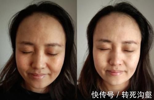 荨麻疹样|4块钱的红霉素软膏成了淡斑专家,营养师,用法和真相要明白