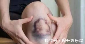 轻松|滑膜炎不能走路?这个方法很厉害,赶走积液很轻松~