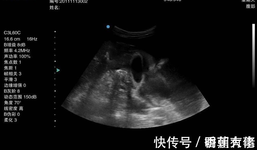 胃癌|一天一个鸡蛋,26岁快递员患上胃癌,医生:这种“鸡蛋”怎能常吃