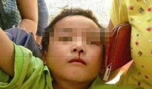 宝妈|3岁男孩摔倒流鼻血,宝妈错误的处理后,医生也“无力回天”