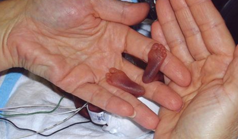 提前|她是世界上最小的婴儿，提前4个月出生，专家称违背医学规律