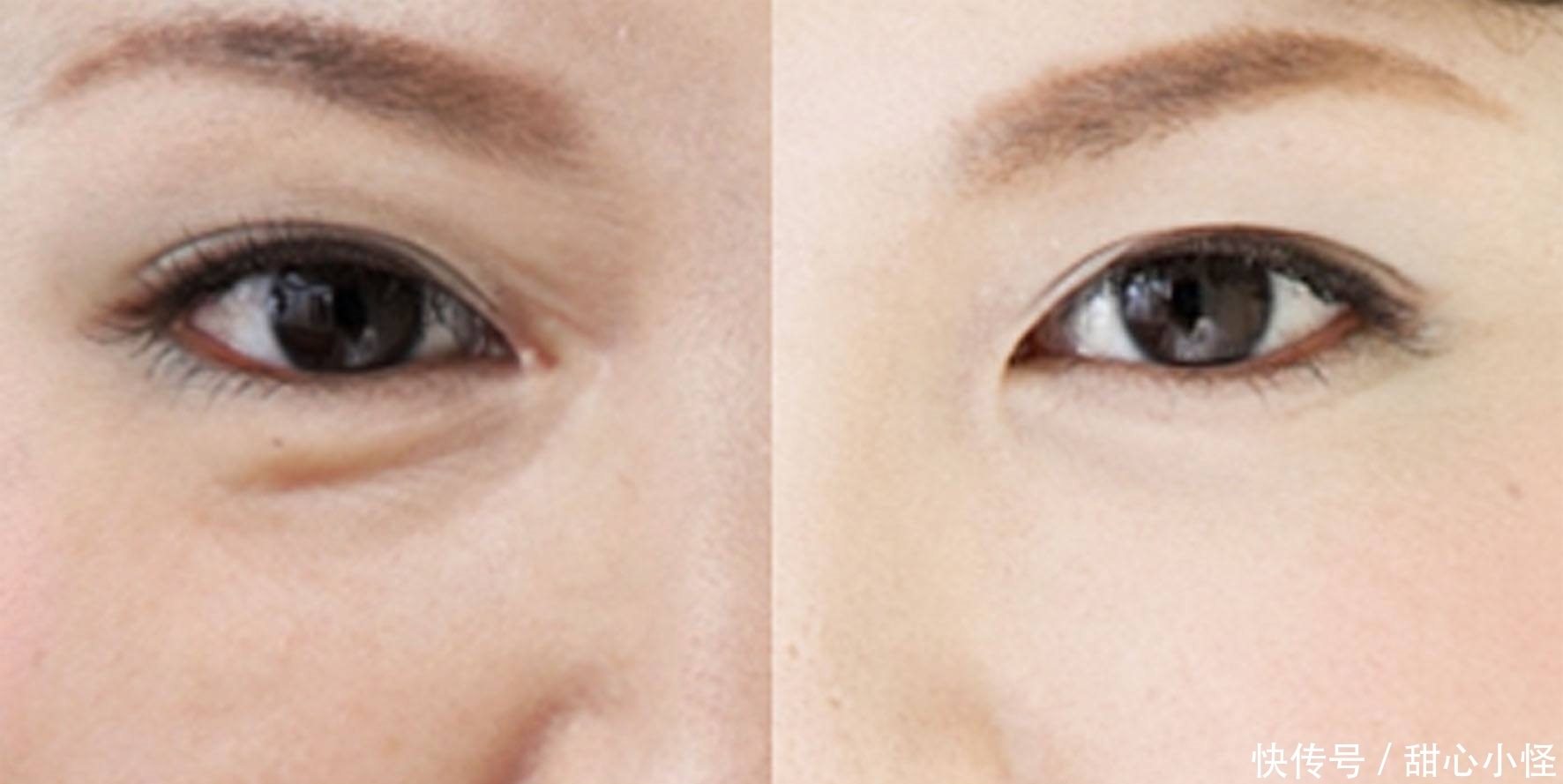 怎样有效快速消除眼袋