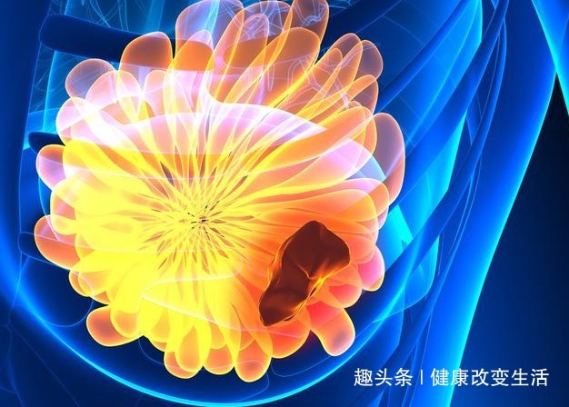 黄花郎地丁茶|乳腺癌开始时,身体有四种迹象,一个不占,你很健康