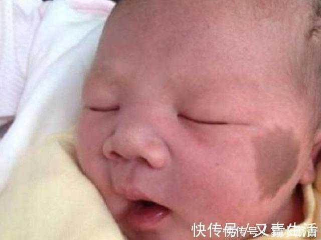 孕期|为什么有的宝宝会有“胎记”产科医生孕期要避免这3种行为