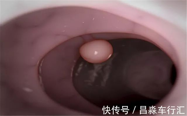 癌变|大家好!我叫“息肉”,癌症的近亲!我最怕无情又温柔的手术刀:艾灸