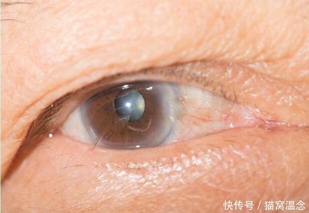 难以|糖尿病患者,血糖若难以控制,就会引发多种并发症,别忽视