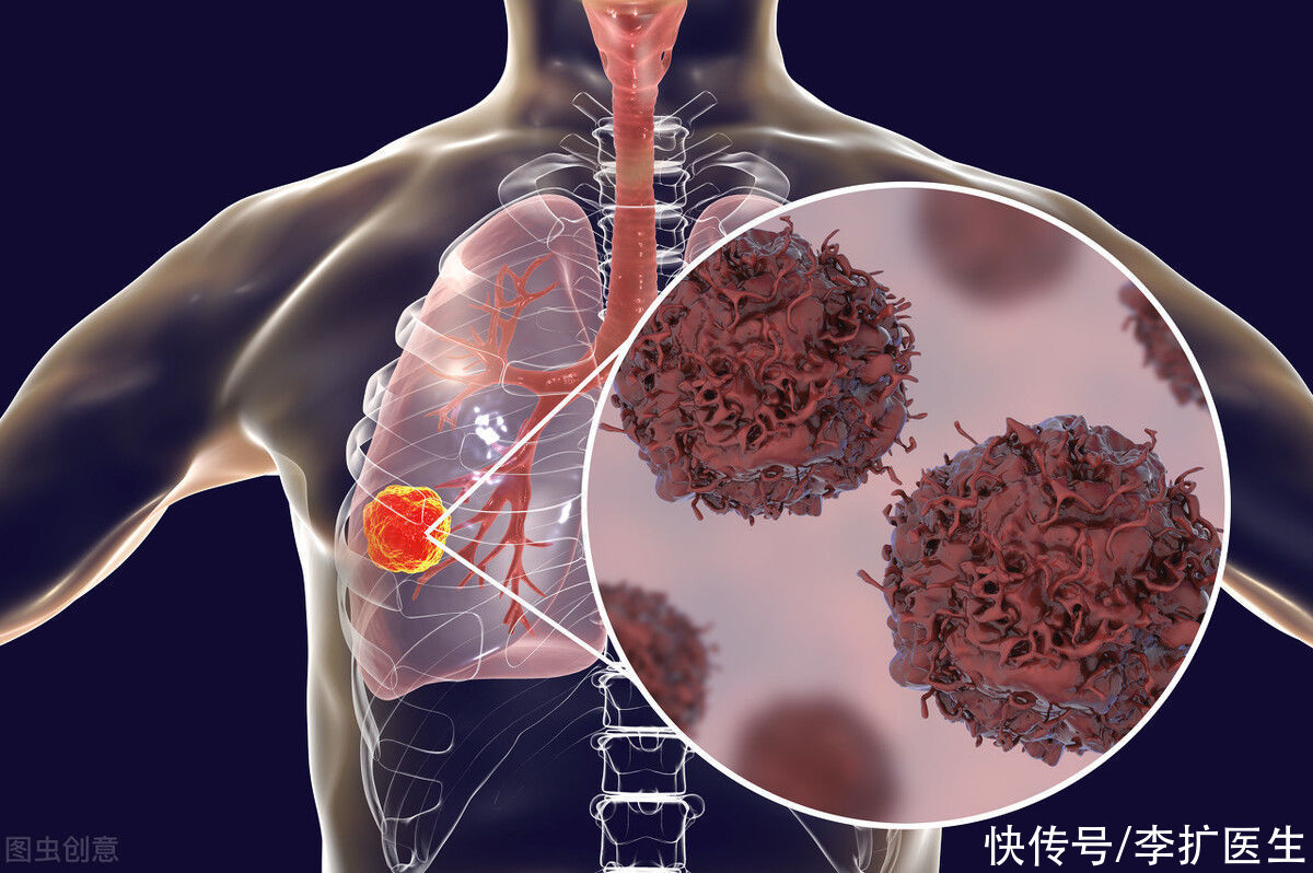 医生|体检发现8mm的肺结节,不想癌症登门,吃什么可以散结?听医生说