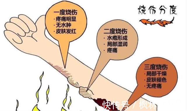 奇奇|男婴被100度开水烫伤后,妈妈做法遭全家反对,却得到医生点赞