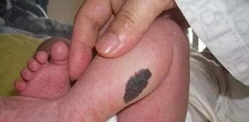 姐姐|“最美胎记”，姐姐在胎中被弟弟吸收，变成胎记留在弟弟腿上