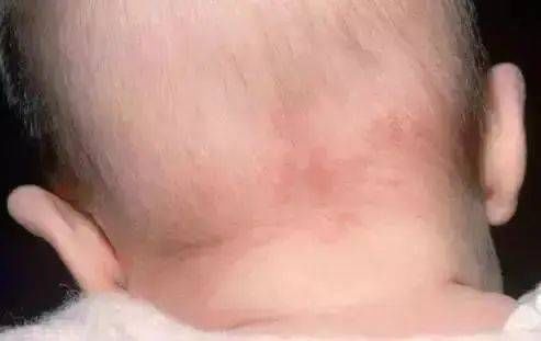 蛋白质|9岁男孩,查出肾衰竭,母亲悔哭不已,提醒:孩子4个地方不能打