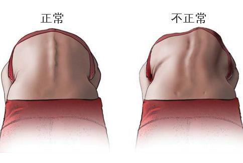 脊柱侧凸|孩子“高低肩”“长短腿”？需要警惕这个病……