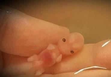 结果|每年因各种原因流掉的胎儿,最后都怎样了?知道结果让人心痛