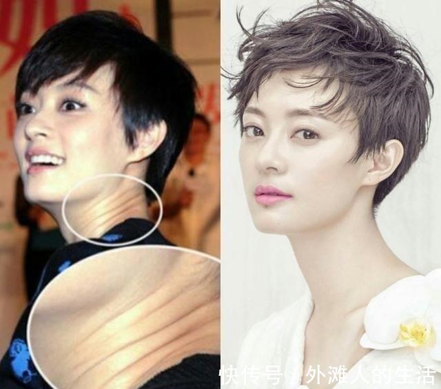 微针 祛颈纹,还是医美最可靠!