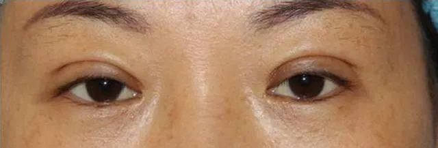 组织|双眼皮术后出现肉条的不同原因和修复方法