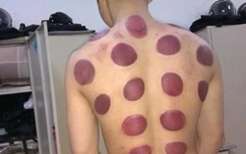 黑印|拔罐的黑印真的是体内毒素吗拔罐师傅给出解释,看完长见识了