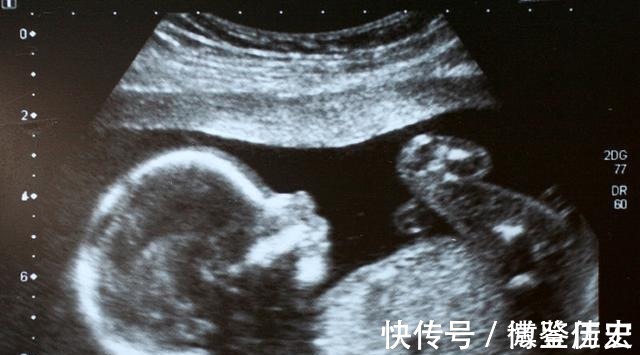 胎儿|孕期检查出胎儿“畸形”,是否应该生下来?专家:这些情况可以生